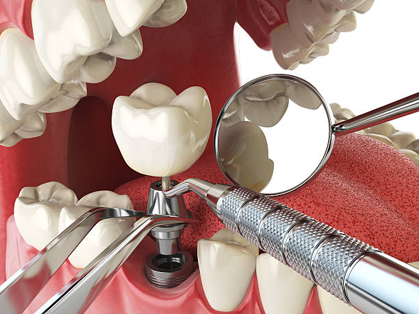 Best Emergency Treatment for Dental Infections or Abscesses in Lincoln, CA